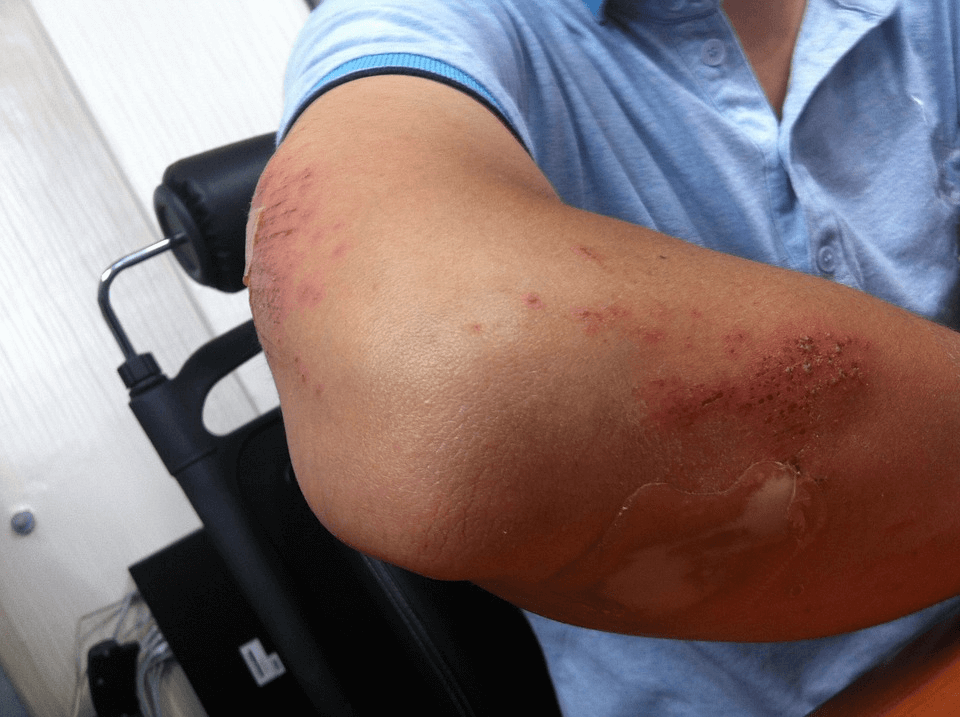 What To Do After Sustaining Injury at Work?